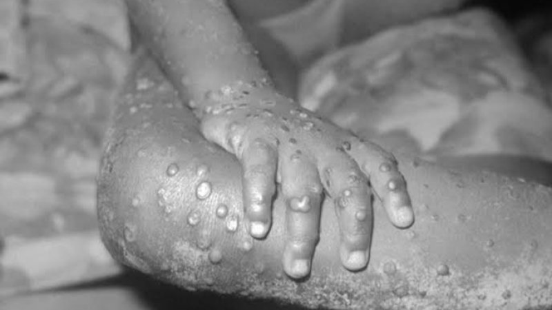د بیزو تڼاکې یا Monkey pox څه ډول ناروغي ده؟ نښې نښانې یې څه دي