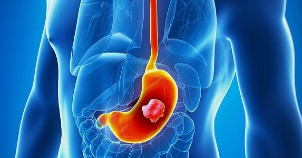 د معدې د سرطان نخښې او لاملونه