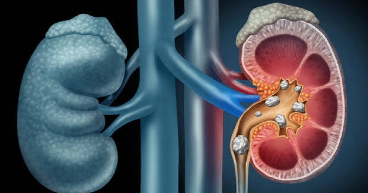 څنګه کولای شو په پښتورګو کې د تيږې جوړېدلو مخنيوی وکړو؟