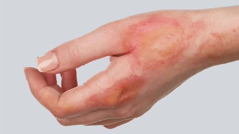 له سوځيدلي کس سره لومړنۍ مرستې