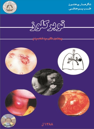 توبرکلوز